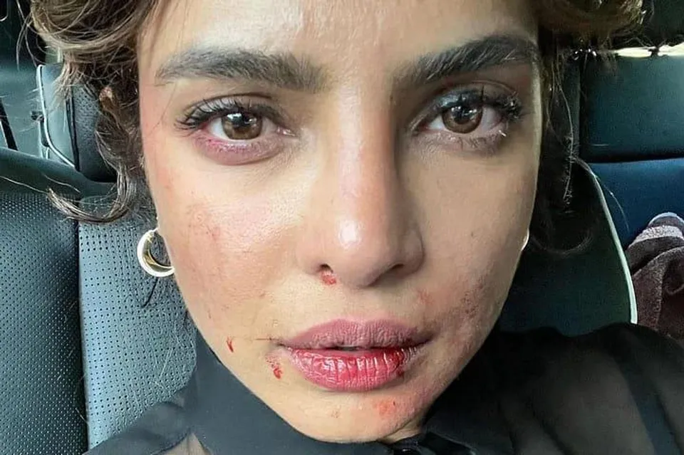 সারা মুখ ক্ষত বিক্ষত কি হয়েছে প্রিয়াঙ্কা চোপড়ার?
