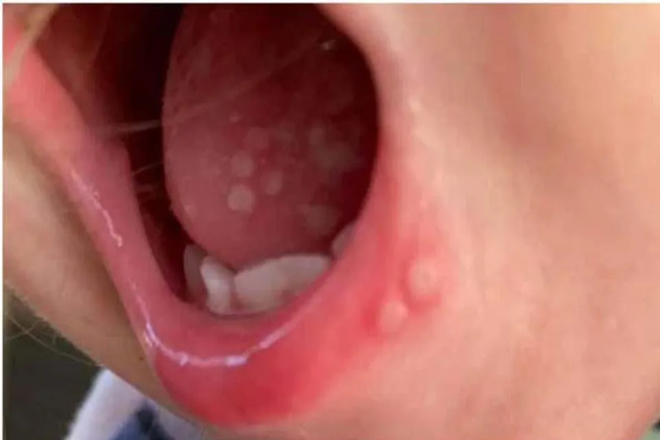 বাংলায় ভয় বাড়াচ্ছে টমেটো-ফ্লু