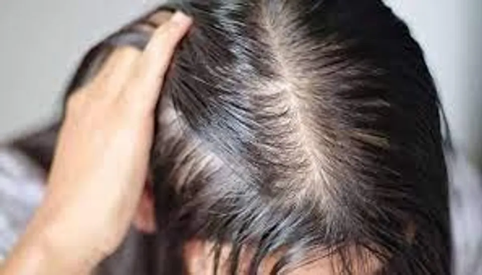 পাতলা চুলের সমস্যা দূর করতে ব্যবহার করুন ভিটামিন ই