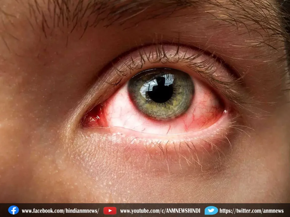eye flu.