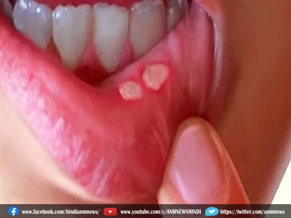 mouth ulcer