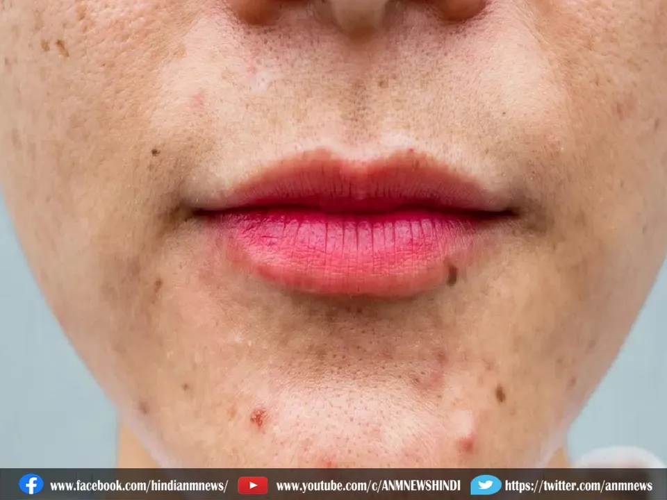 spotless skin