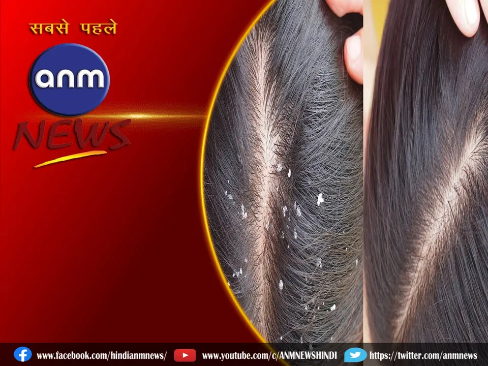 dandruff