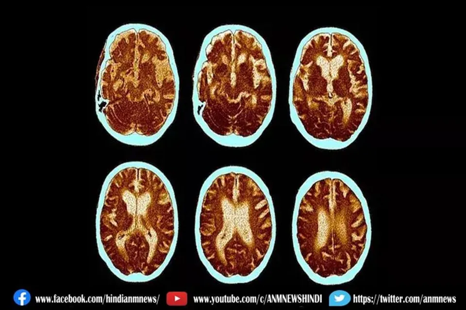 एपस्टीन बार वायरस हर्पीस वायरस परिवार का सदस्य है
