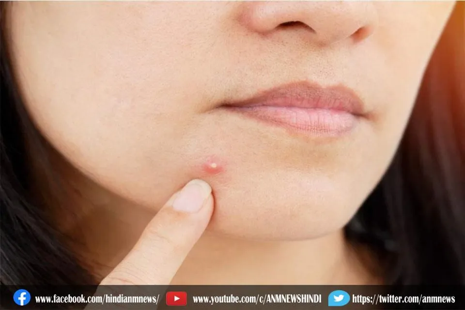 मुंहासे निकले की झंझट खत्म कर देंगे ये 3 उपाय