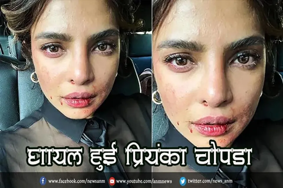 घायल हुई प्रियंका चोपड़ा