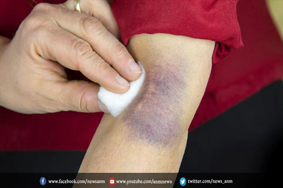 क्या है सेनाइल परप्यूरा?