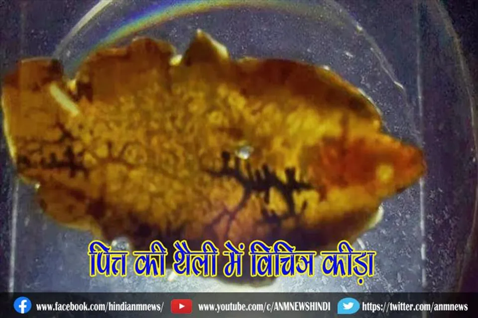 पित्त की थैली में विचित्र कीड़ा