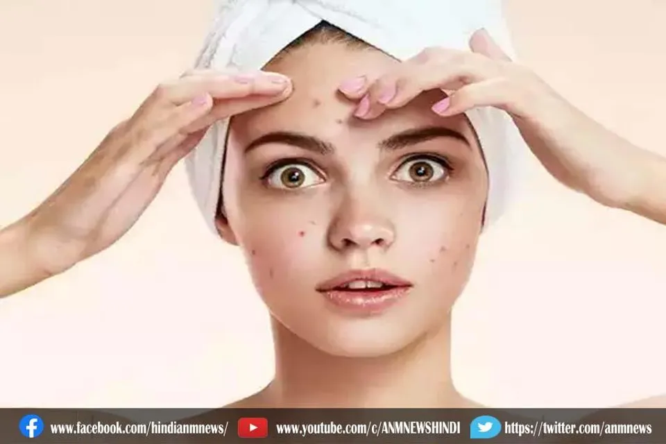 मुंहासे फोड़ने से बन जाएंगे बदसूरत