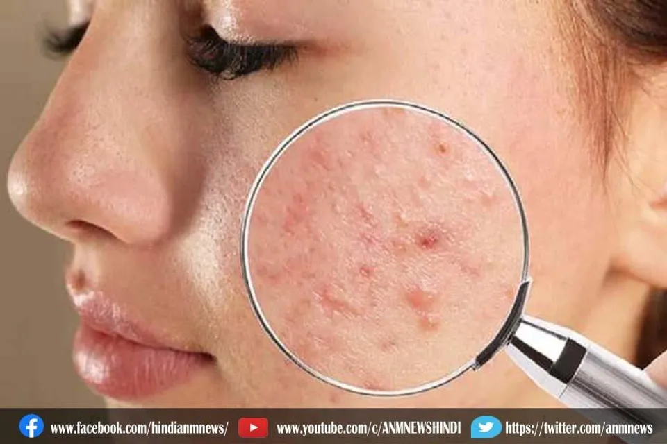 पिम्पल्स निकलने की इन वजहों के बारे में नहीं जानते ज्यादातर लोग