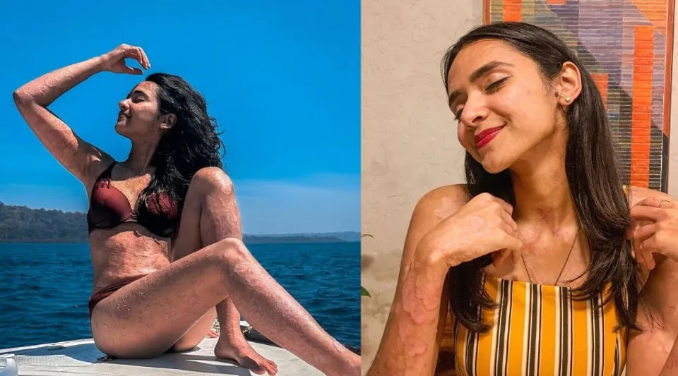 Shrestha Tiwari On Dealing With Psoriasis And Why Skin Positivity Is The Need Of The Hour