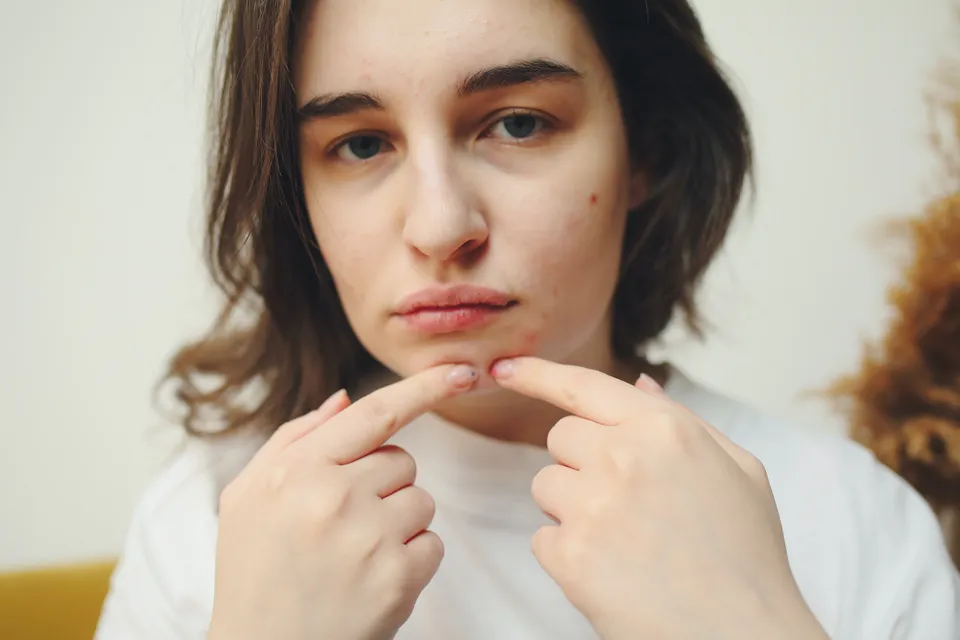 Everything You Need To Know About Fungal Acne Including Why It Shouldn't Be Called That