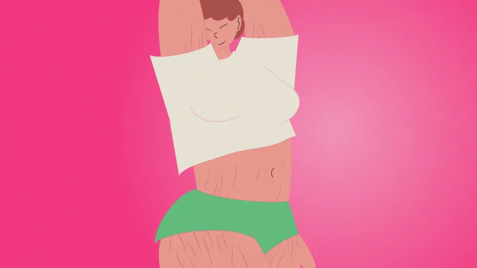 An illustration of a woman with stretch marks on her arms and thighs
