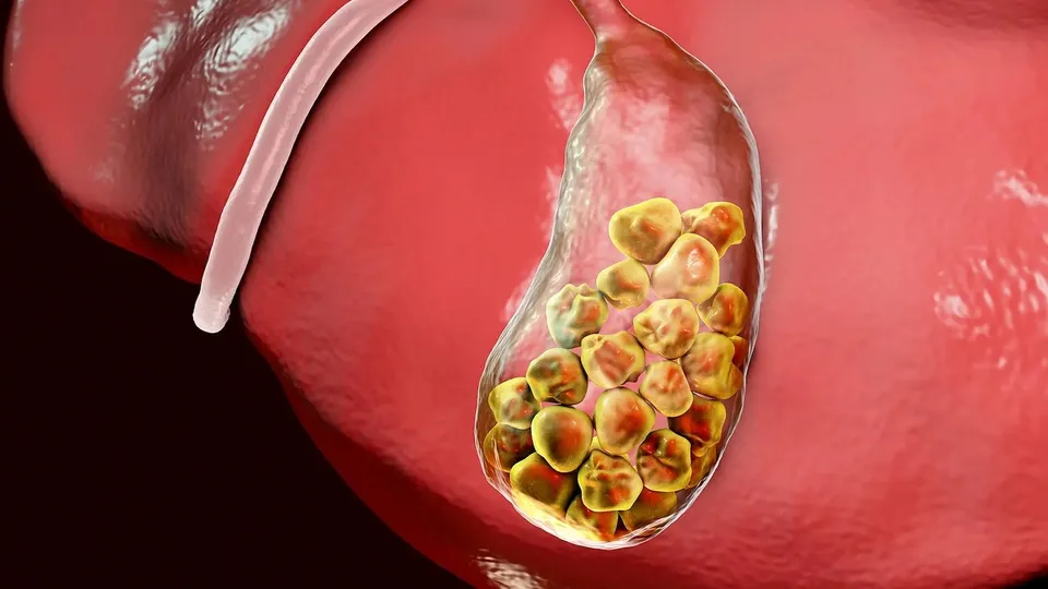 gallstones