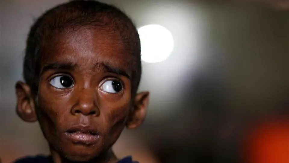 Malnourished child.jpg