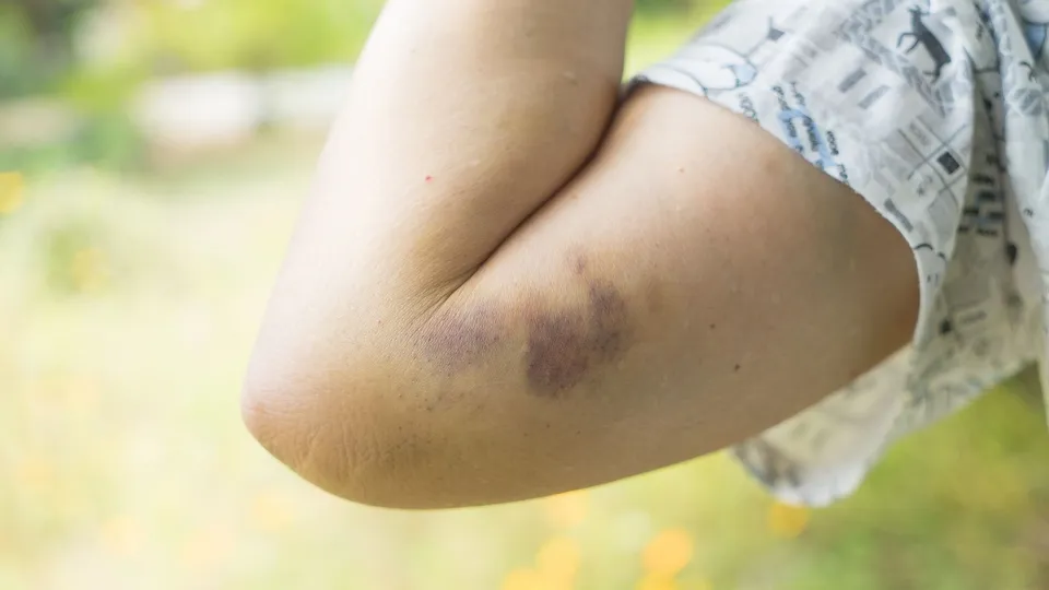 bruise.jpg
