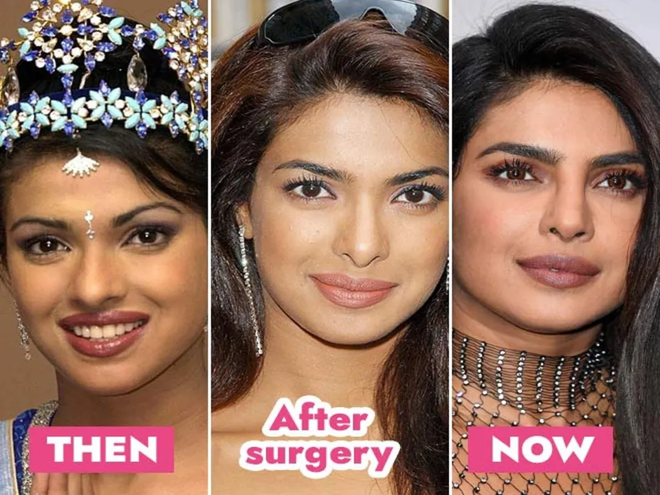 priyanka chopra surgery.jpg