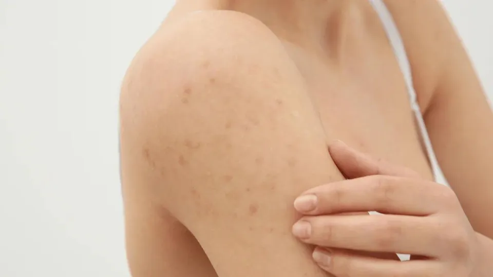 NSW scabies outbreak