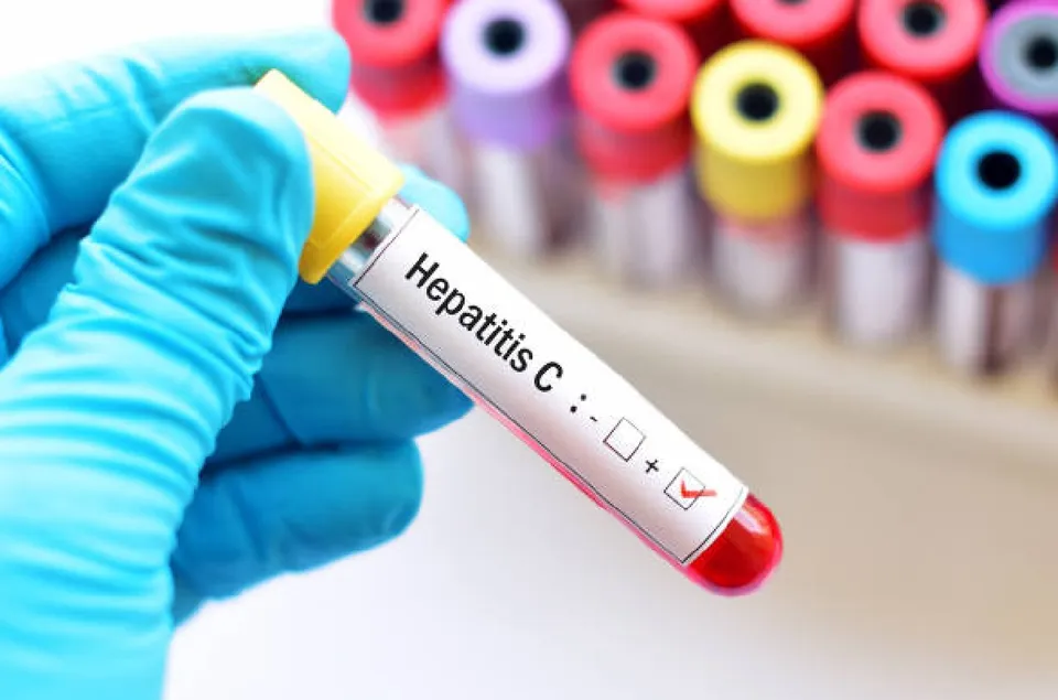 hepatitis c jaundice