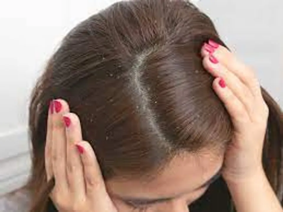 താരന്‍ അകറ്റാനും തലമുടി വളരാനും സഹായിക്കുന്ന ചില ഹെയര്‍ പാക്കുകളെ പരിചയപ്പെടാം...