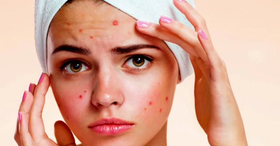 മുഖക്കുരു വരാതിരിക്കാന്‍ ചെയ്യേണ്ട കാര്യങ്ങള്‍