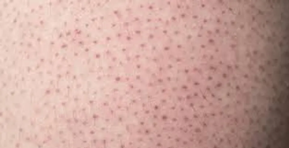 'സ്ട്രോബെറി സ്കിൻ' ഒഴിവാക്കാനായി ചെയ്യാവുന്ന ചില ടിപ്സ് കൂടി അറിയാം..