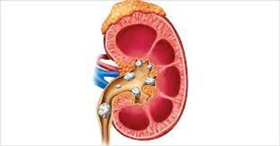 വിട്ടുമാറാത്ത വൃക്കരോഗം ഹൃദയ സംബന്ധമായ അസുഖത്തിനുള്ള അപകട ഘടകമാണെന്ന് ഗവേഷണം