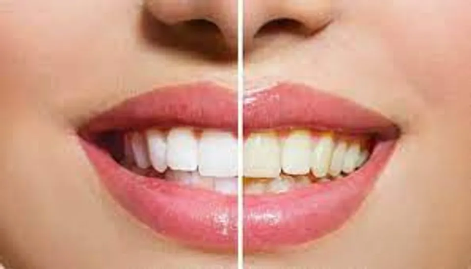 പല്ലിന്റെ മഞ്ഞനിറം മാറാനുള്ള വഴികൾ എന്തൊക്കെയാണെന്ന് നോക്കാം..