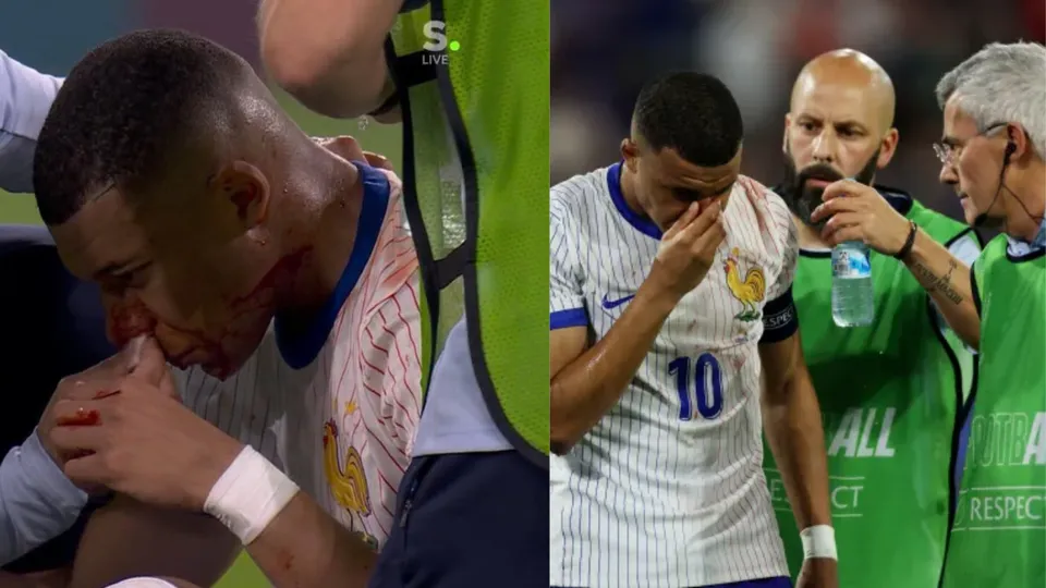 UEFA Euro 2024: Kylian Mbappe taken off the field after picking up nose injury during clash against Austria 