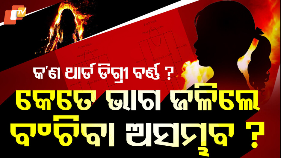 Burn Injuries:ମଣିଷ ଶରୀରର କେତେ ଭାଗ ଜଳିଗଲେ ବଂଚିବା ଅସମ୍ଭବ...ଜାଣନ୍ତୁ ଏହି ରିପୋର୍ଟରେ