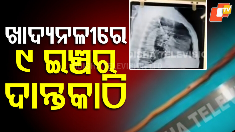 Toothpick in Man's Esophagus : ଖାଦ୍ୟନଳୀରୁ ବାହାରିଲା ୯ ଇଞ୍ଚର ଦାନ୍ତକାଠି