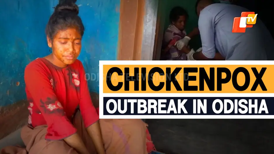 3 Critical, 30 Affected Due To Chickenpox Outbreak In Odisha’s Gajapati District