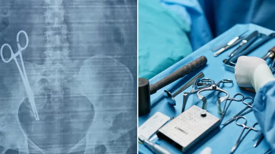 Gross medical negligence: Scissors left in woman’s stomach detected after 17 years